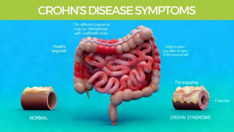 Crohn’s Disease Symptoms natural herbal treatment