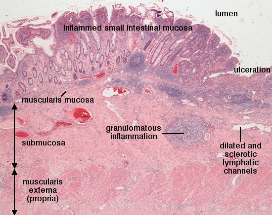 Crohn's Disease