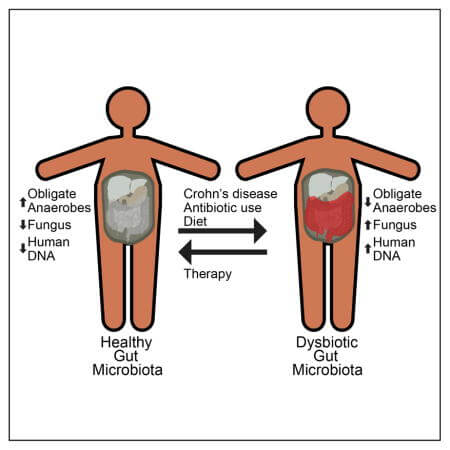 Chrons disease gut imbalance