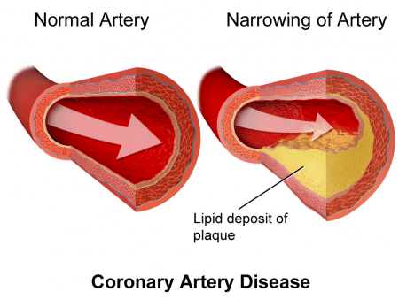 Cholesterol in artery Cholesterol in artery