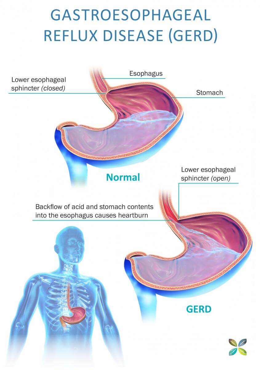How acid reflux occurs in the body 