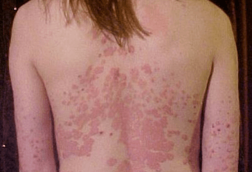 The expression of TAM receptors and their ligand Gas6 is downregulated in psoriasis