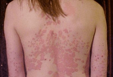 Comparison of Immune and Barrier Characteristics in Scalp and Skin Psoriasis