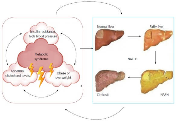 fatty liver and metabolic syndrome