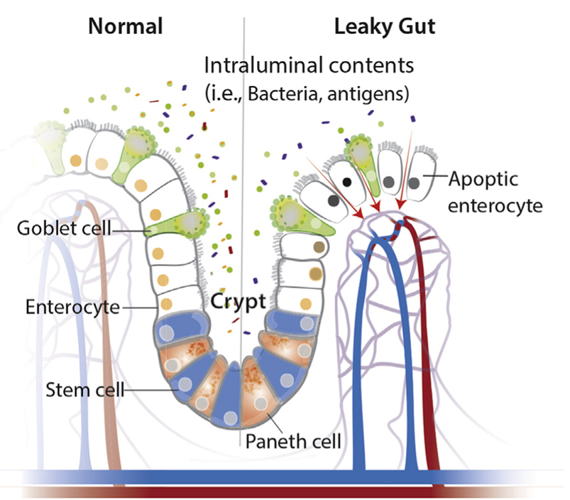 healthy gut versus leaky gut infographic